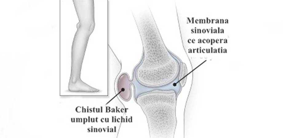 deteriorarea sacului sinovial al genunchiului supramax osteo farmacia tei