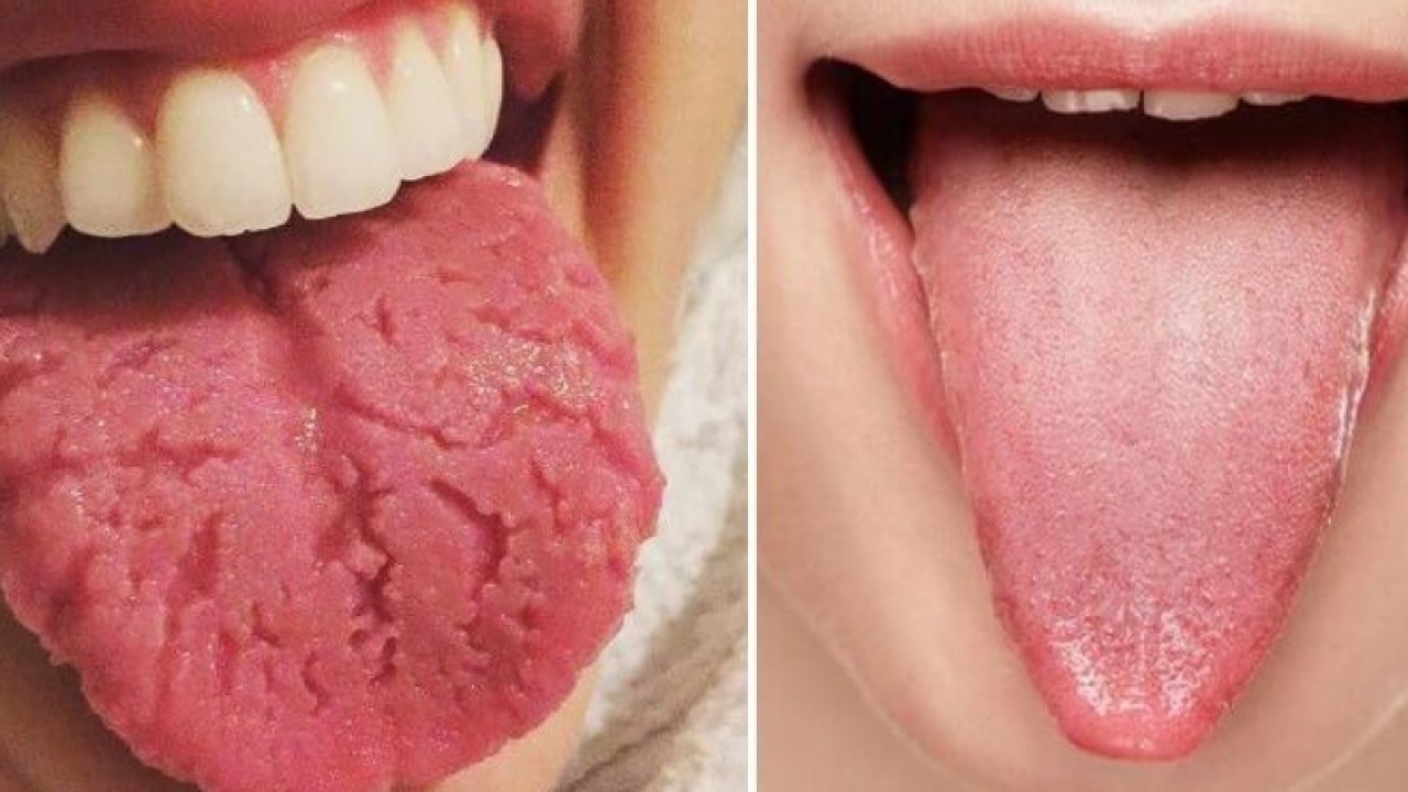 Cureaua de limba (Ankyloglossia) - Viață sănătoasă 