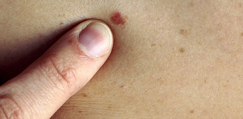 tipuri de cancer de piele