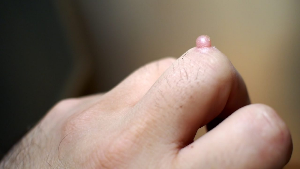 papillomavirus and age tratamentul calusurilor uscate pe picioare între degete