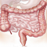 Cancer de colon – cauze, simptome, diagnostic, tratament