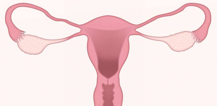 Ruperea chistului ovarian - Tumoare