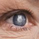 cataracta, boli oftalmologice