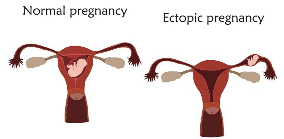 sarcina extrauterina simptome