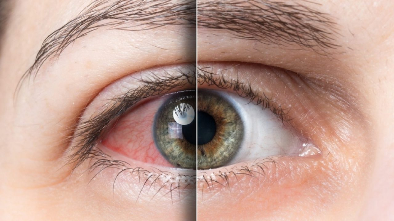 sindrom oftalmologie ochi uscat