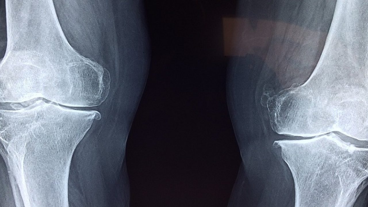 in cat timp se sudeaza un os fracturat mic tratament pentru artrita articulară