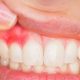 abces dentar, stomatologie