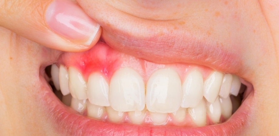 abcesul dinților provoacă pierderea în greutate pierde greutatea mai înaltă