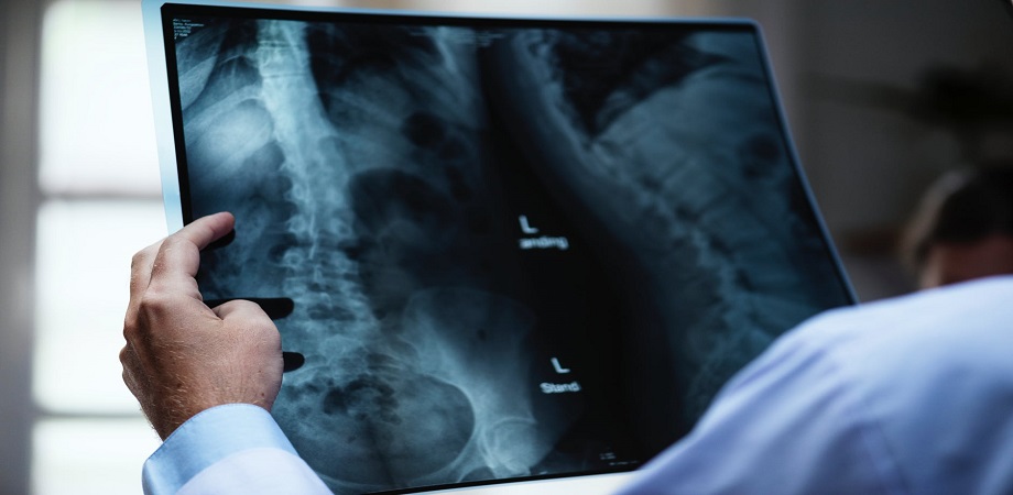 radiografie coloana vertebrala