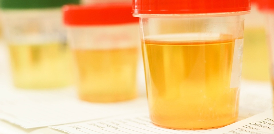 acid uric din urina