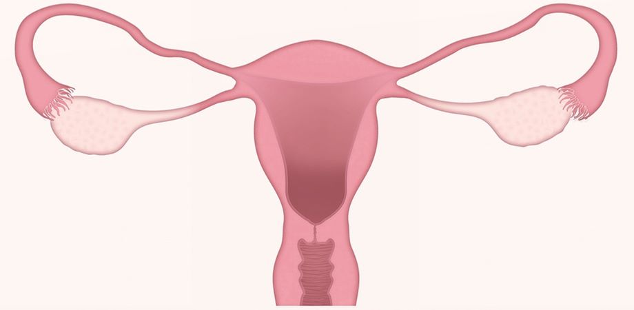 histerectomie uterina