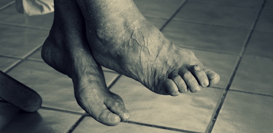 consecine de tratament pentru picior în picioare