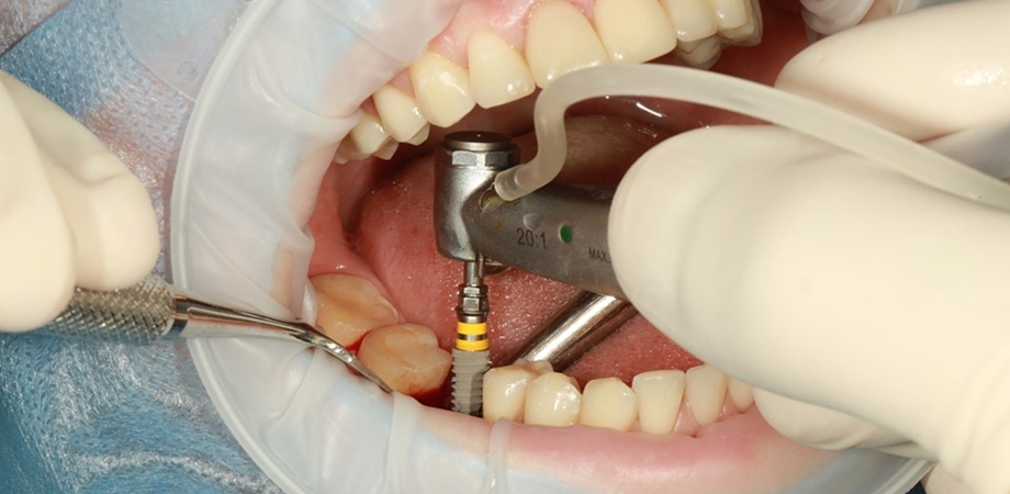 implant dentar avantaje