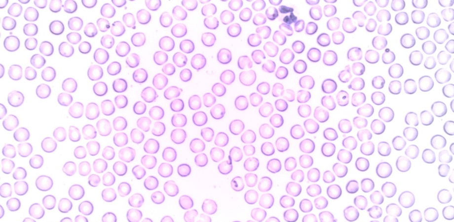 Leucocitoza sau numarul crescut de globule albe
