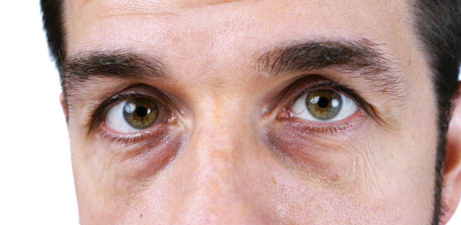 cearcane negre sub ochi cauze relaxarea mușchilor faciali de la riduri