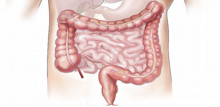 Sindromul intestinului scurt