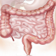 Intususceptia intestinala