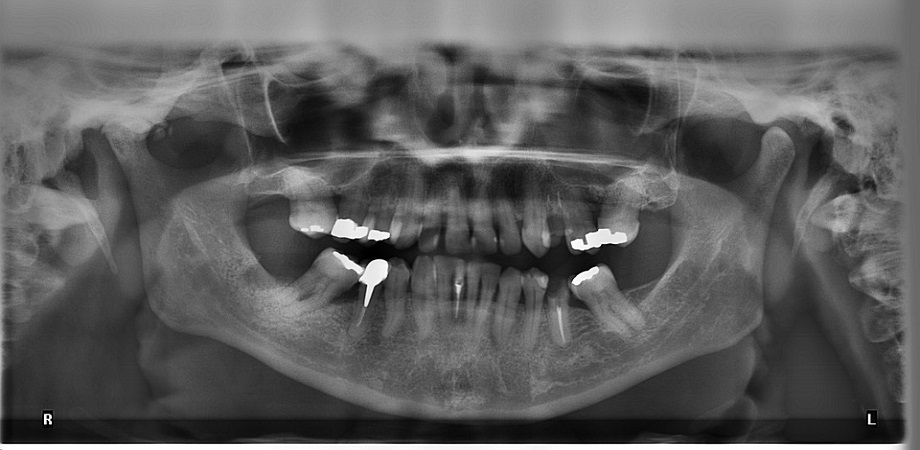 Interpretare radiografie dentara