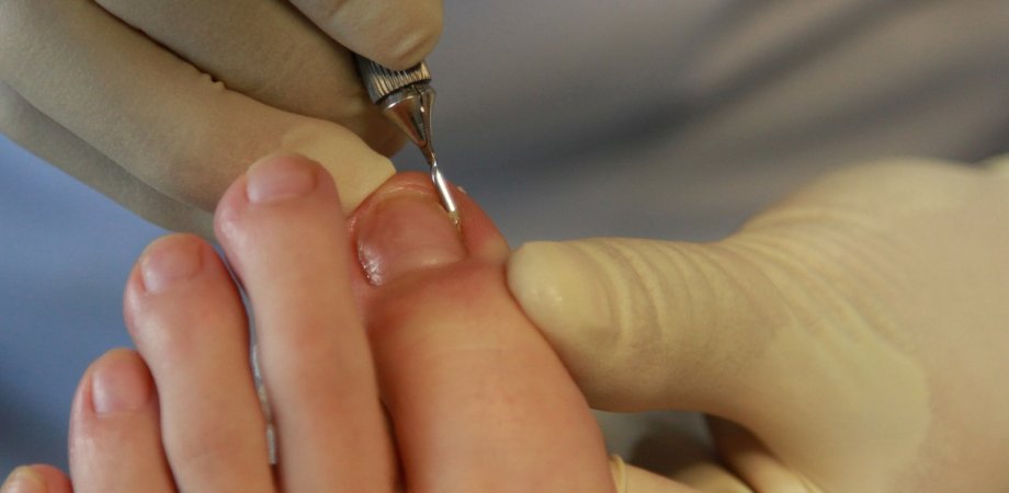 tratamentul infectiilor la unghii